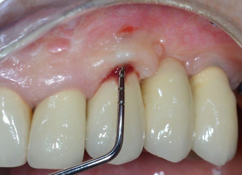 Ultrasonic Cavitation and Peri-Implantitis