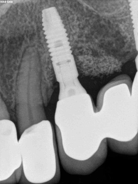 Ultrasonic Cavitation and Peri-Implantitis