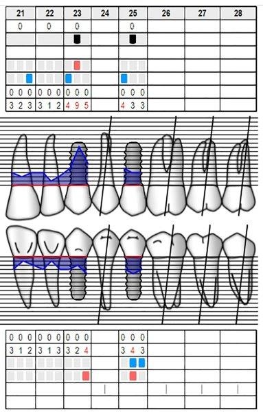 Ultrasonic Cavitation and Peri-Implantitis