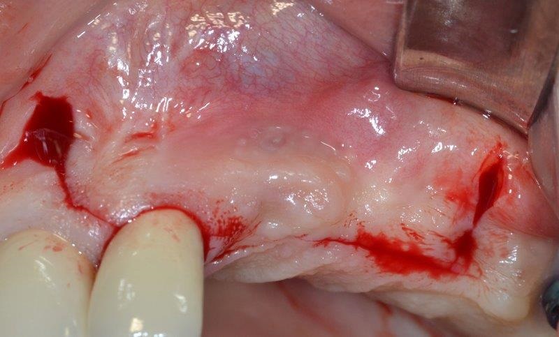 Ultrasonic Cavitation and Peri-Implantitis