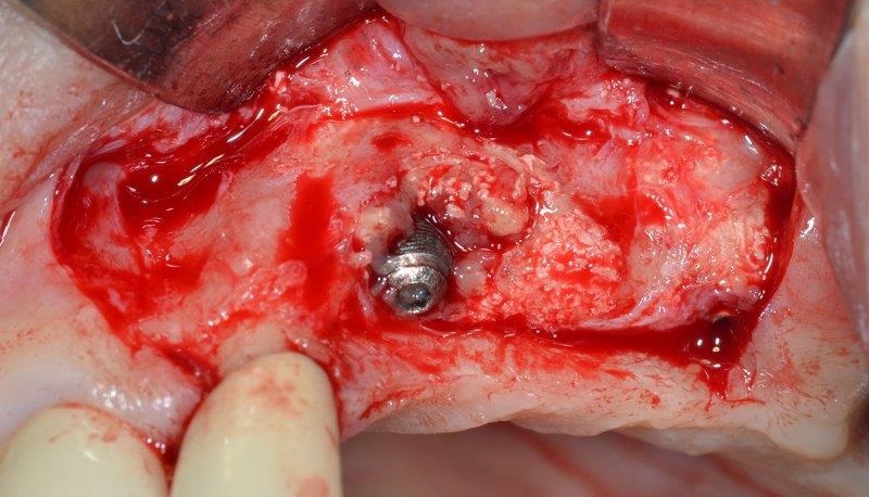 Ultrasonic Cavitation and Peri-Implantitis