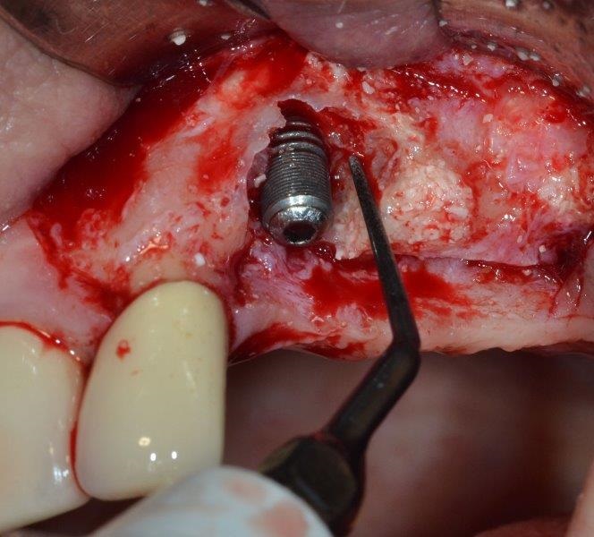 Ultrasonic Cavitation and Peri-Implantitis