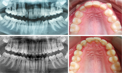 Clinical Case Spotlight: Nonextraction Nonexpander Treatment