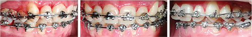 Clinical Case Spotlight: Nonextraction Nonexpander Treatment