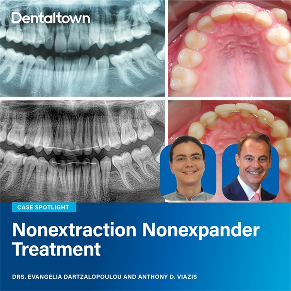 Clinical Case Spotlight: Nonextraction Nonexpander Treatment