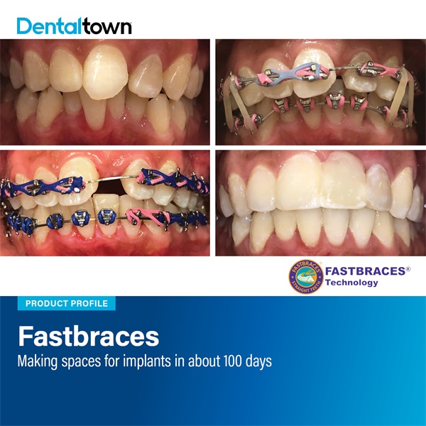 Product Profile: Fastbraces