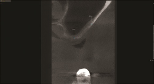 Elevating Implant Success