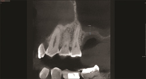 Elevating Implant Success