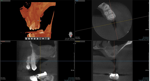 Elevating Implant Success