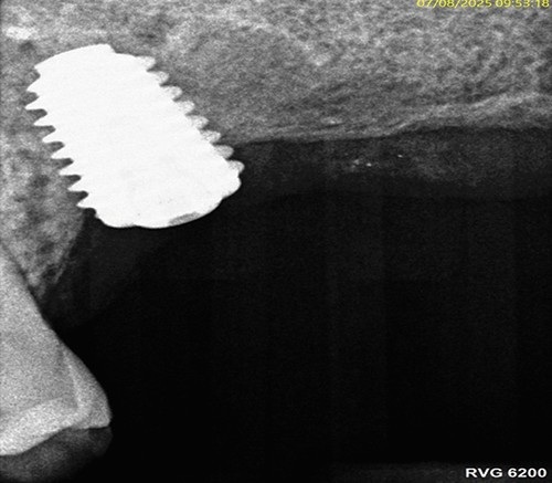 Elevating Implant Success