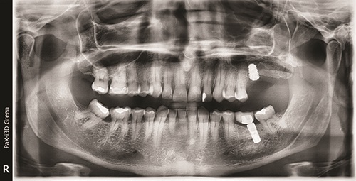 Elevating Implant Success