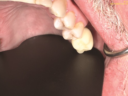 Elevating Implant Success