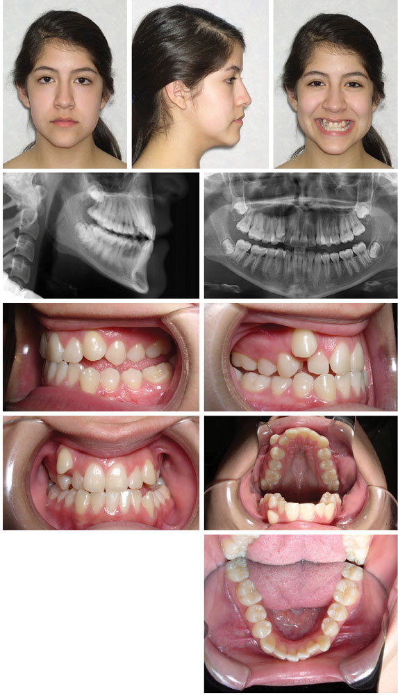 Diastema Closure Kit and Direct Bond Retainers – Orthodontic Supply &  Equipment Company