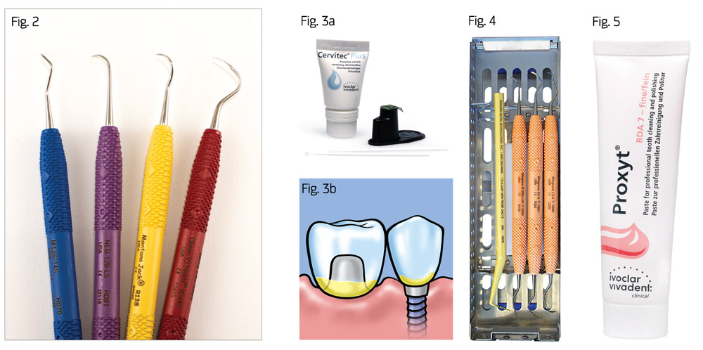 Two Keys to Periodontal and Peri-Implant Treatment Success