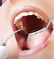 by Lorraine Frey, RDH, LDH, BAS, Periodontal Probes: An Overview of History, Evolution and Clinical Technique 