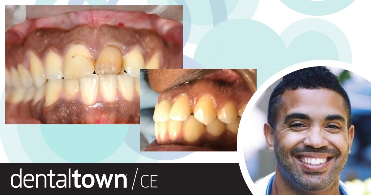 Front-Line Work: Anterior Immediate Implant Strategies for General Dentists