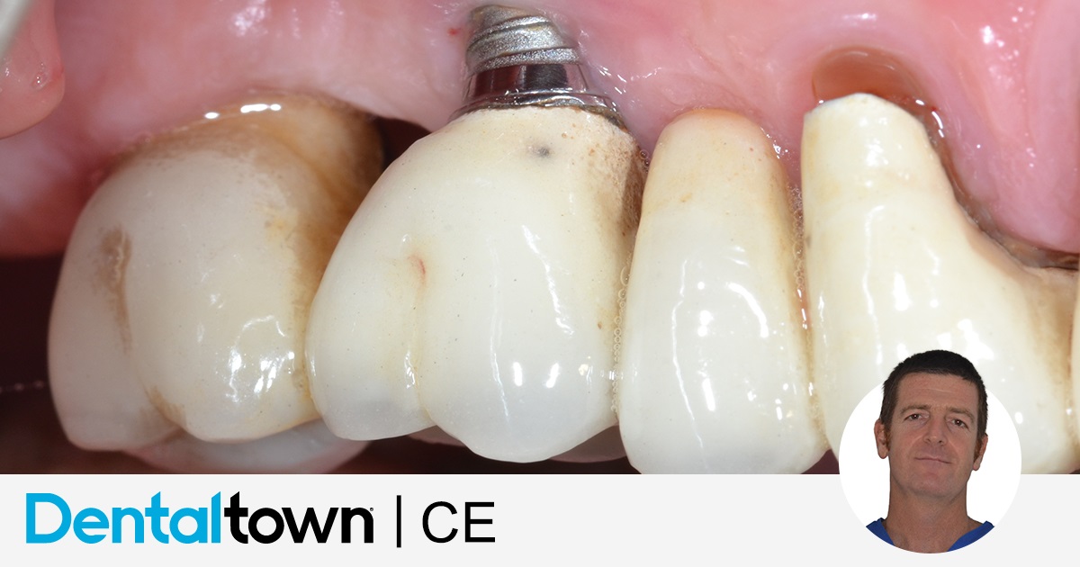 Peri-Implantitis: Its Diagnosis and Management 