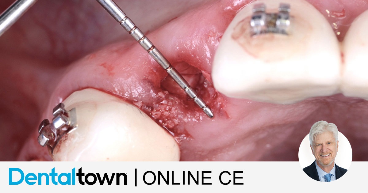 One-Step Alveolar Ridge Preservation Without the Need for a Membrane