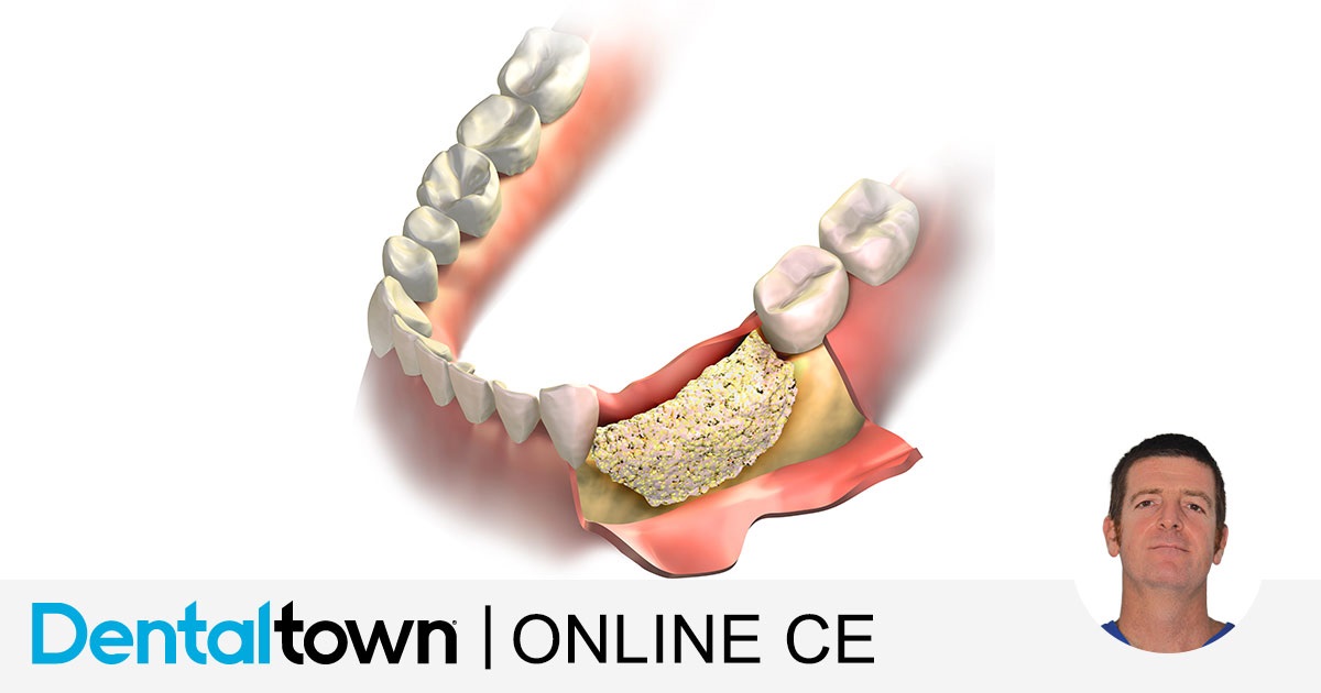 All You Ever Needed to Know About Guided Bone Regeneration