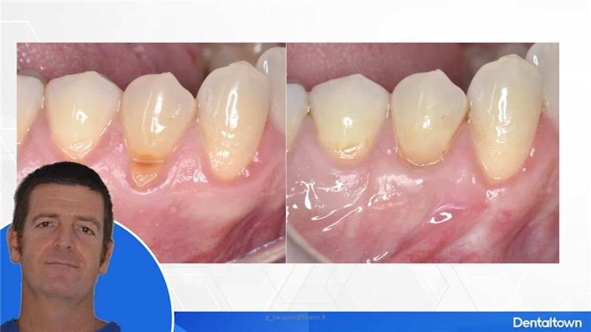 Mucogingival Aesthetic Surgery