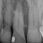 Periapical Image Tooth 11