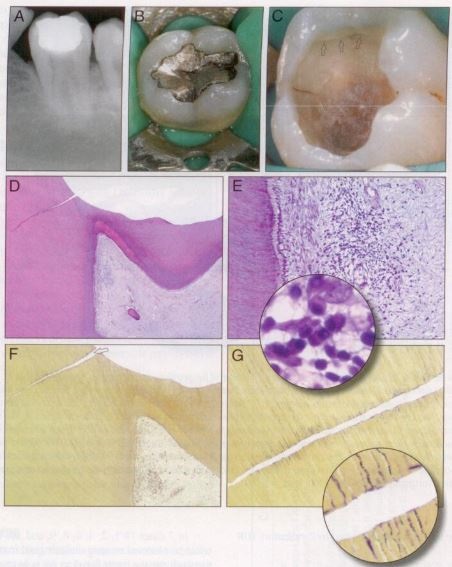 E Inflammatory cell (lymphocytes) infiltrate subjacent to crack x400