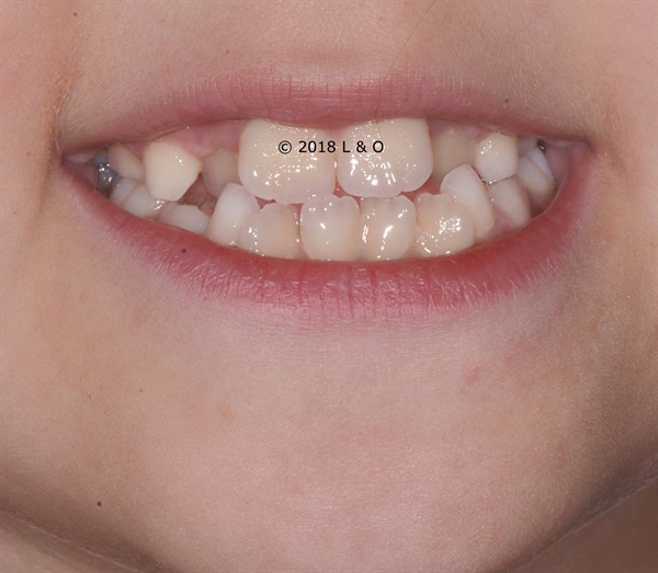 Talking About Pediatric Orthodontics