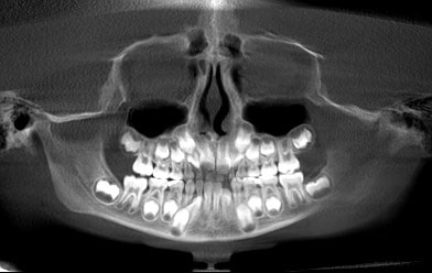 The Great Distress: Ectopic Teeth in a Smile and in Orthodontics