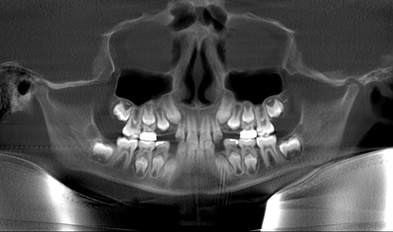 The Great Distress: Ectopic Teeth in a Smile and in Orthodontics