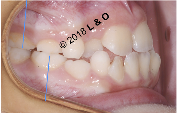 Talking About Pediatric Orthodontics