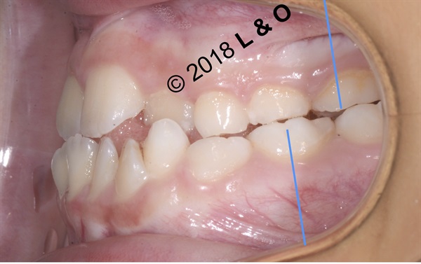 Talking About Pediatric Orthodontics