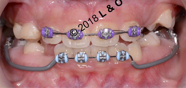 Talking About Pediatric Orthodontics