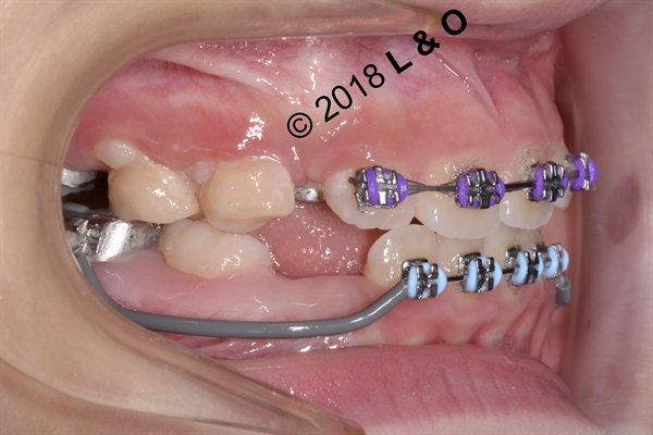 Talking About Pediatric Orthodontics