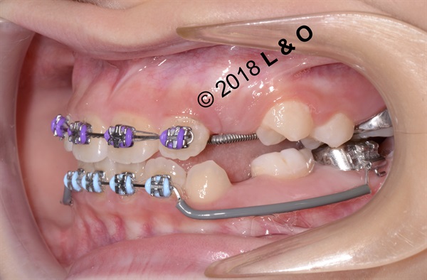 Talking About Pediatric Orthodontics