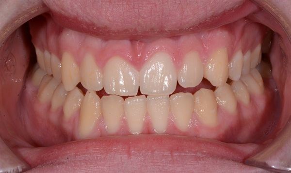  Orthodontics: How You Start Finishing at the Beginning and Reduce the Stress at the End for You and Your Patient