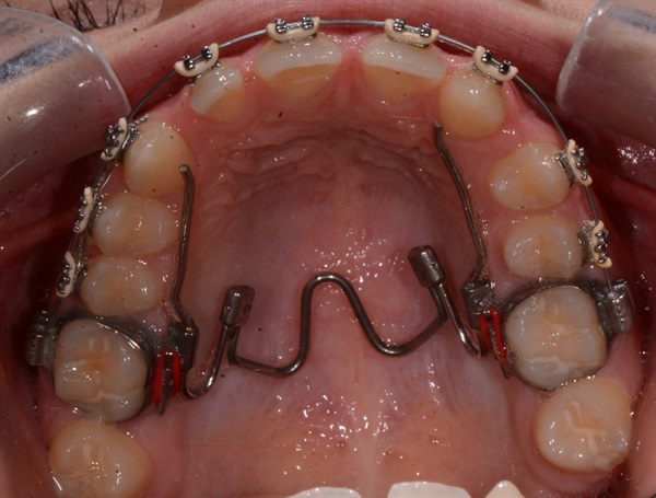 Ortho Case Finishing: The In-Treatment-Presenting-Posterior Crossbite