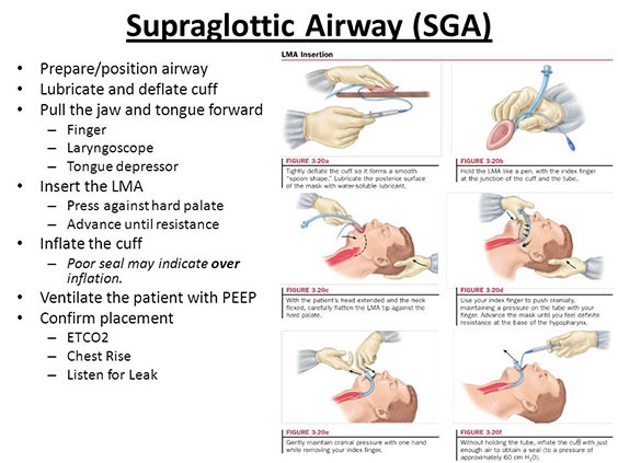 How to Recognize and Treat Laryngospasm